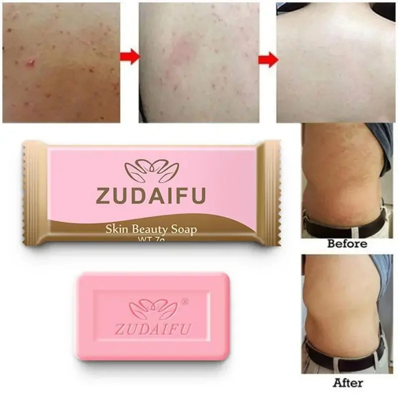 바디워시 Sulfur Anti-mites Anti-acne Body Cleansing Skin Treatment Soap  Anti Fungus Soap Beauty Health Kojic Acid Soap Kojic Acid